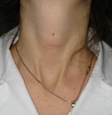 Cirugia Tiroides  Cicatriz estetica